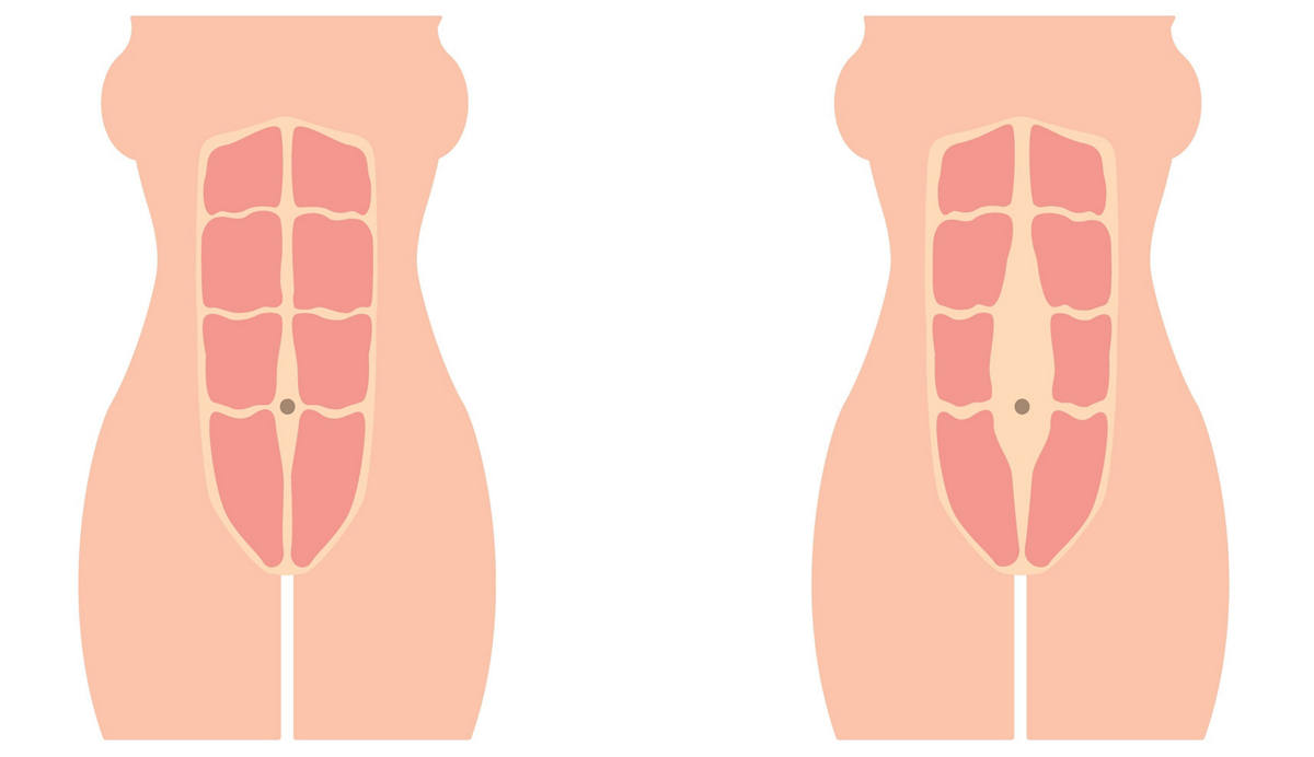 Bauchmuskulatur vor, während & nach Schwangerschaft 