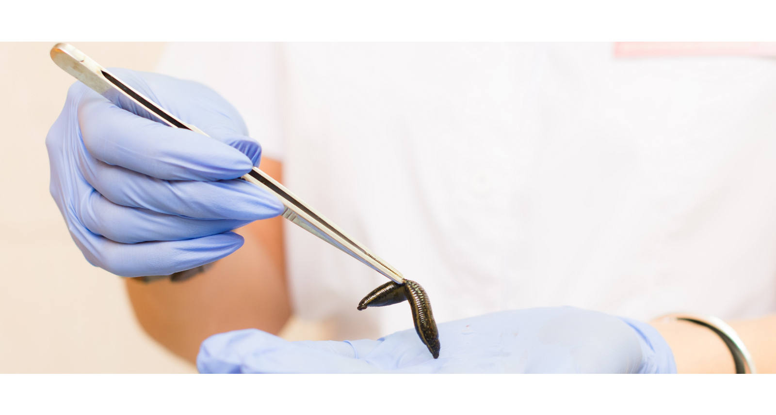 Terapia con le sanguisughe: a cosa serve il metodo di cura alternativo?